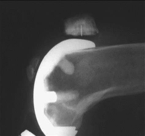 Periprosthetic Fractures Associated With Total Knee Arthroplasty Bone