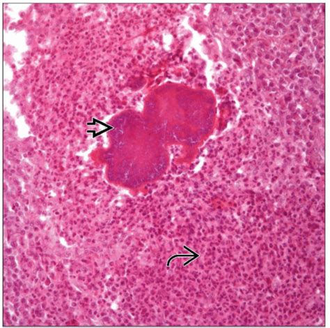 Botryomycosis | Basicmedical Key