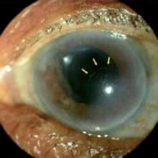 Slit Lamp Photograph Fth Postoperative Day Showing Curvilinear