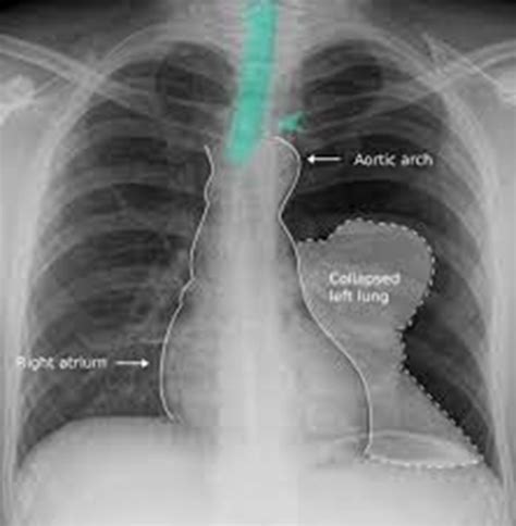 Chest Trauma And Chest Tubes Lower Respiratory Pt N Exam