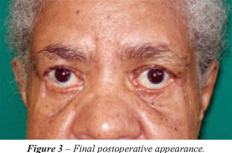 Figure 3 From Eyelid Polyposis Caused By Eccrine Hidrocystoma Polipose