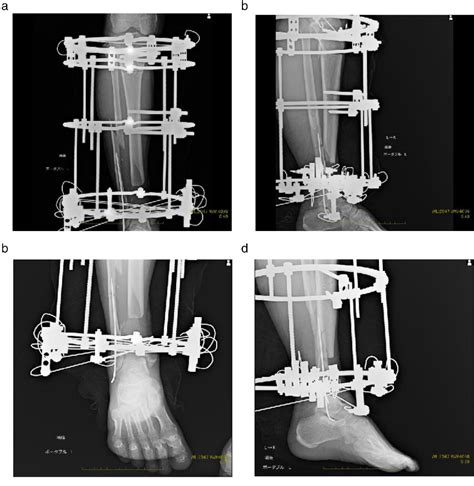 Figure 4 From Ankle Joint Reconstruction By Circular Frame External