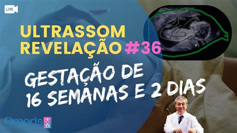 Gravidez Semanas Descobrindo O Sexo Do Beb Ao Vivo Ultrassom