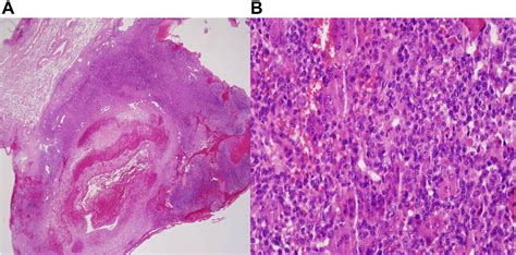 Figure From A Case Of Pulmonary Metastasis Of Giant Cell Tumor Of