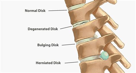 Homeopathy Treatment Of Slipped Disc