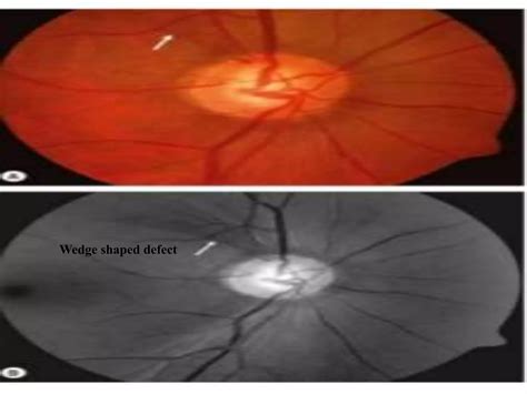 Optic nerve and its disorders | PPT