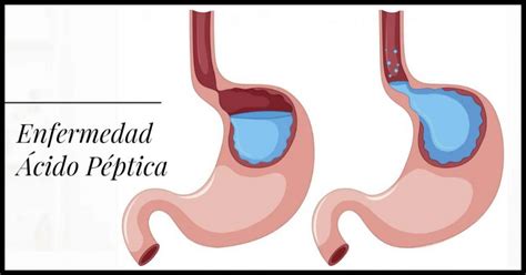 Enfermedad Cido P Ptica Reflujo Gastroesof Gico Factores S Ntomas