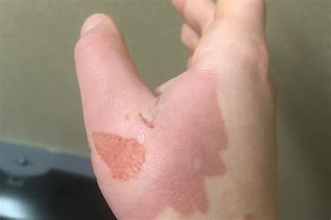 Second Degree Burn Healing Process Pictures