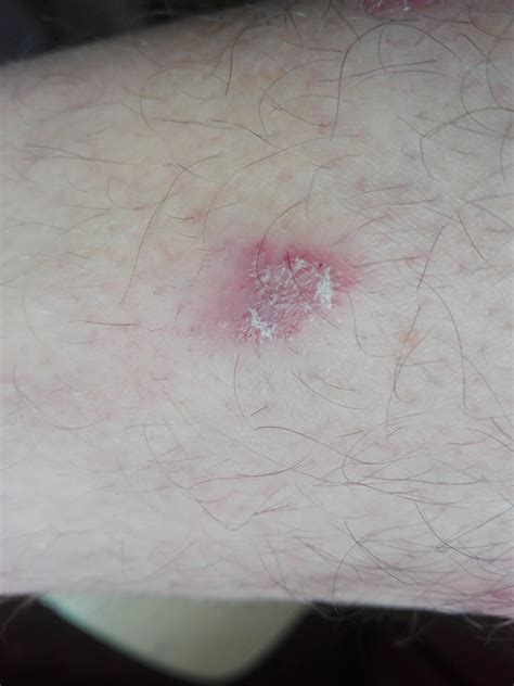 Раны на ноге не заживают - Вопрос дерматологу - 03 Онлайн