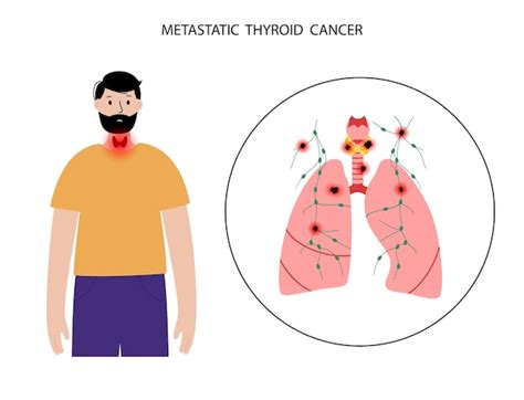 Premium Vector | Thyroid cancer stages