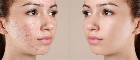 An Experts Guide To Acne Vulgaris Treatment At Home Makeo Skinnsi