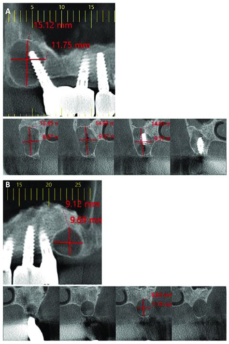 Cone Beam Computerized Tomography CBCT Of The Surgical Ciliated Cysts