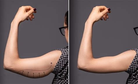 CoolSculpting Arms Before And After Phonemantra