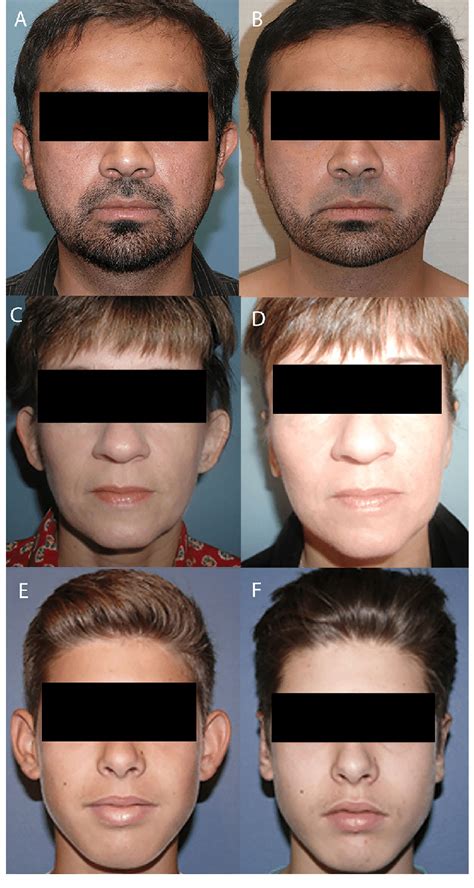 Preoperative A C And Postoperative D F Otoplasty Results