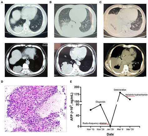 Frontiers Genomic Profiles Of A Patient Of Pulmonary Hepatoid