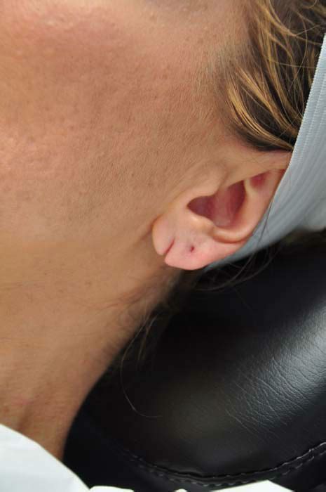 20 minute procedure can repair ripped earlobes | abc13.com