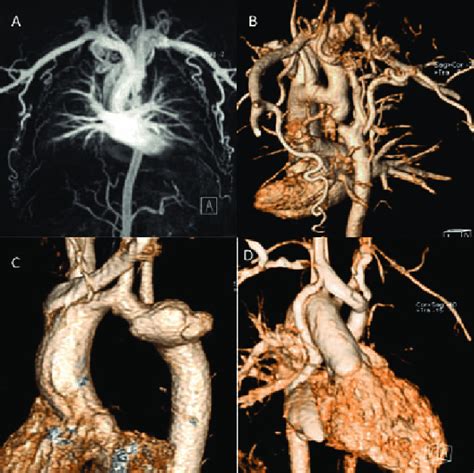 Contrast Enhanced Cmr Angiography Severe Coarctation With Large Download Scientific Diagram