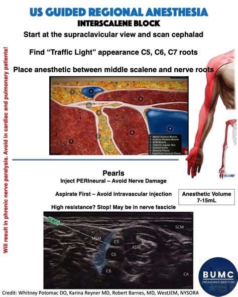 Nerve Block Interscalene Bumcem