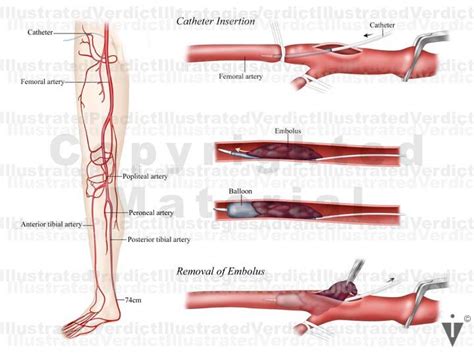 Stock Lower Limb Clots Plaques In Vasculature Illustrated Verdict