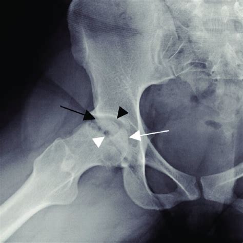 Right Sided Femoral Head Collapse White Arrow With Subchondral Cystic