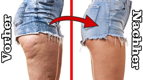 Bindegewebe St Rken Einfache Tipps Gegen Cellulite Und