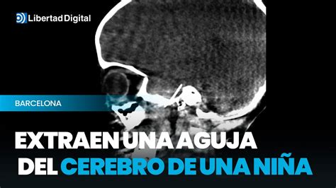 Extraen Una Aguja Del Cerebro De Una Niña De 4 Años Vídeo Dailymotion