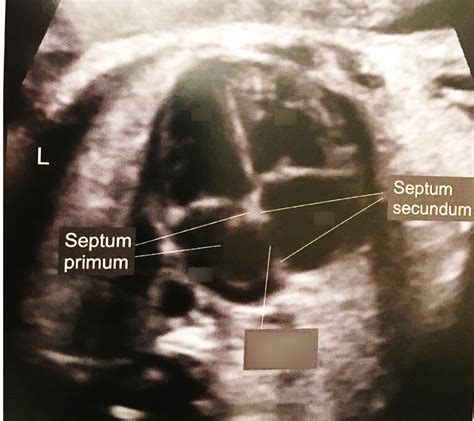 Fetal Heart Diagram Quizlet