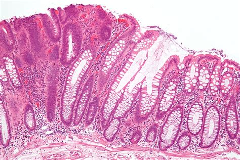 Filetubular Adenoma 2 Intermed Mag Wikimedia Commons