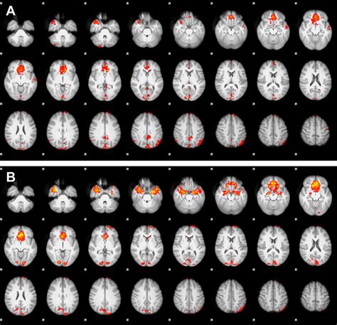 Mean Difference In FMRI Activity Between The Interference And Control