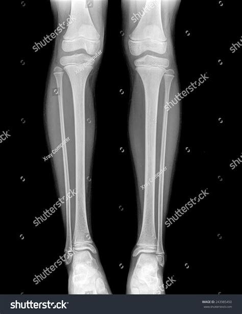 Leg Xray Images Stock Photos Vectors Shutterstock