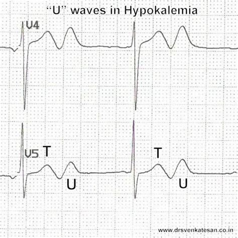 Hypokalemia U Wave Ecg 2 Ekg Medicine Nurse