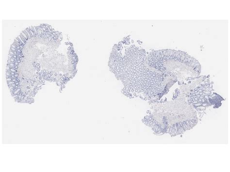 7 Amyloidosis Amyloid Deposition Histopathology Atlas