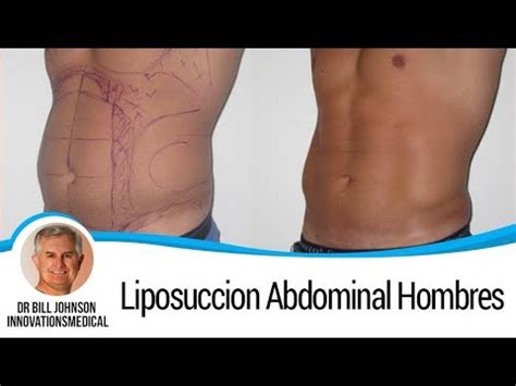 Lipoescultura De Estomago Abdomen Y Cintura Innovaciones Medica Youtube