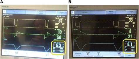 Myths And Misconceptions Of Airway Pressure Release Ventilation