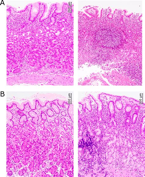 Histological Findings HE 100 A Nodular Gastritis Left Corpus