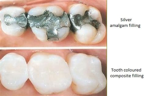 How Dental Fillings Help Save Teeth Midtown Dental Logan Ut