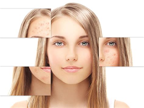 Tratamento de Acne Iluna Na Pele BH Clínica de estética e