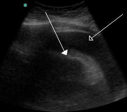 Pericardial effusion echocardiography - wikidoc