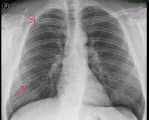 Fratura da costela no tòrax sintomas tratamento e tempo de recuperação