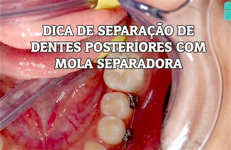 Sepração No Dente Da Fretne E Caracteristica Dxe Q Nacinlaidede