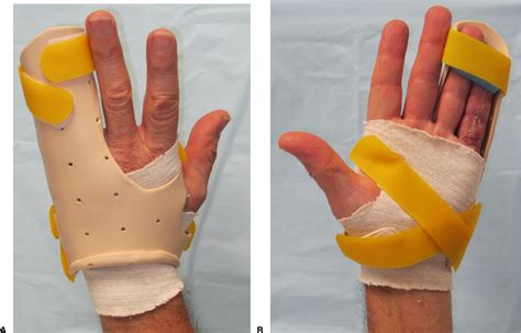 The Effect Of Night Extension Orthoses Following Surgical Release Of