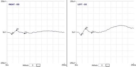 ERG responses. ERG recordings showing severely reduced responses for... | Download Scientific ...