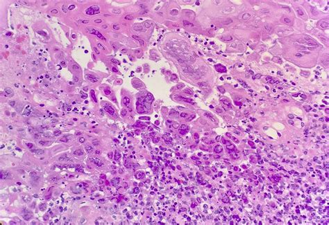 Pathology Outlines Herpes Simplex Esophagitis