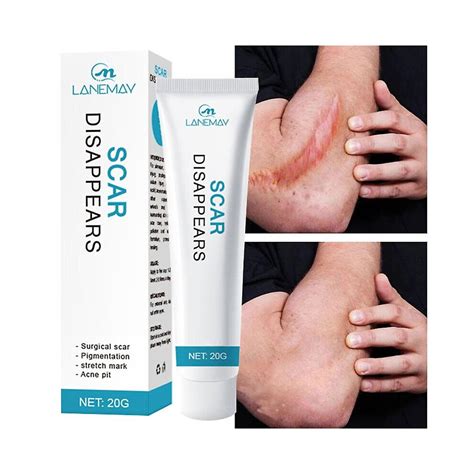 Scar Removal Cream Repair Stretch Marks Burn Acne Surgical Acne Scar