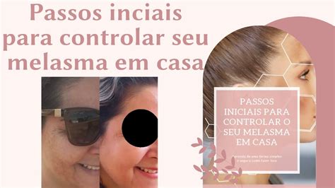 Passos Iniciais Para Controlar O Melasma Em Casa Manchas Melasma