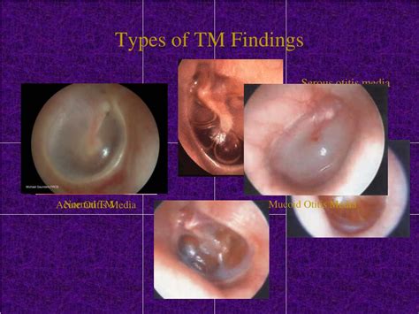 Ppt Ear Tubes Powerpoint Presentation Free Download Id547563