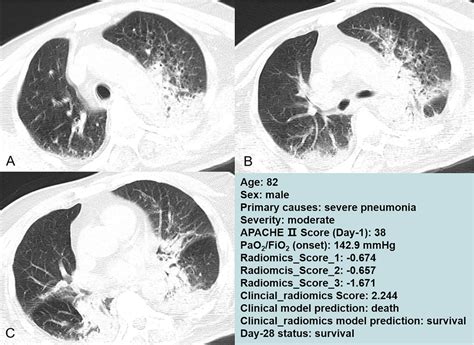 Chest CT Images Of An 82 Year Old Male Admitted To The Intensive Care