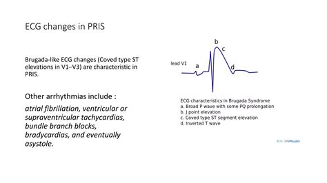 Propofol Infusion Syndrome Ppt