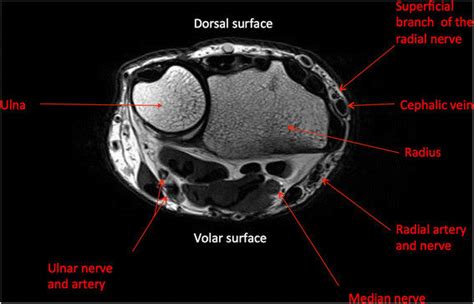 Wrist Magnetic Resonance Imaging Anatomy T Weighted Axial View