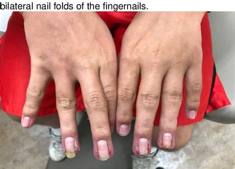 Isotretinoin Induced Nail Fold Pyogenic Granuloma Resolution With